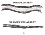 arterial-vasospasm