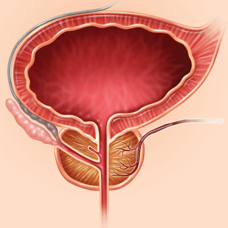 What You Should Know About Prostate Artery Embolization Pae Memphis