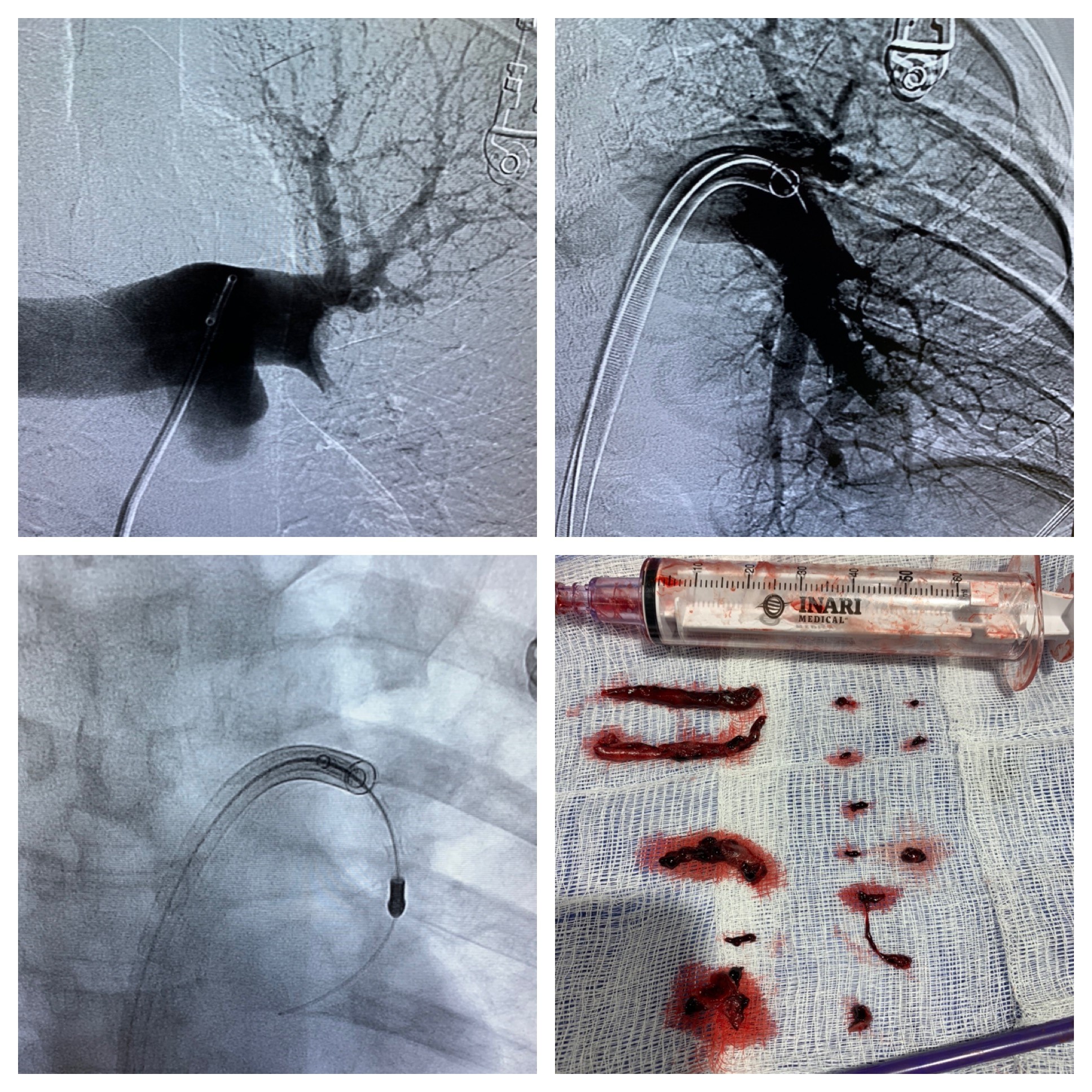 Treating Pulmonary Embolism at the source Memphis