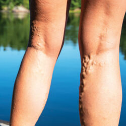 Steps You Can Take To Decrease Symptoms Of Varicose Veins - Memphis ...