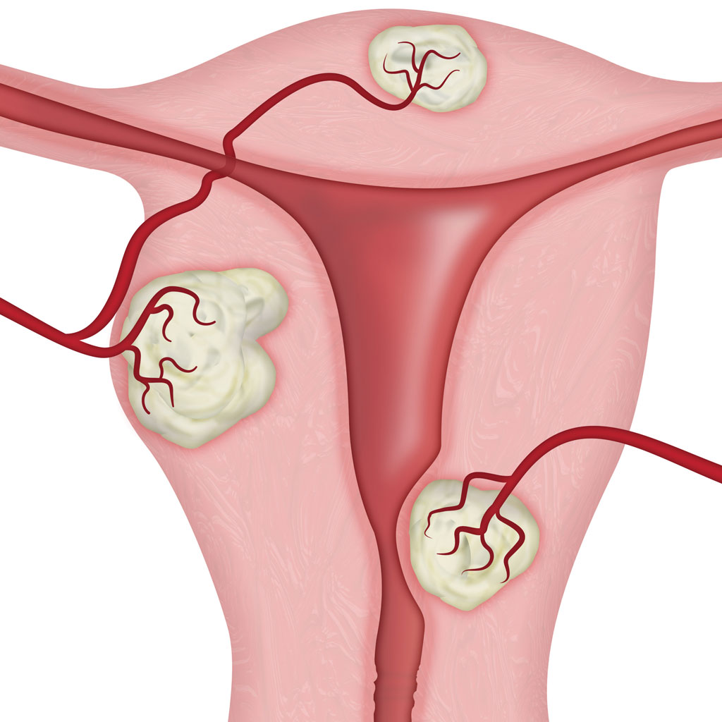 About Uterine Fibroid Embolization Memphis Vascular Center