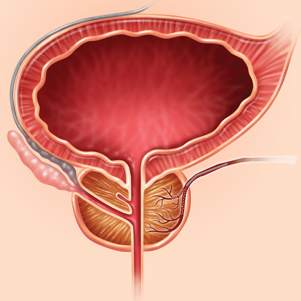 what-you-should-know-about-prostate-artery-embolization-pae-memphis