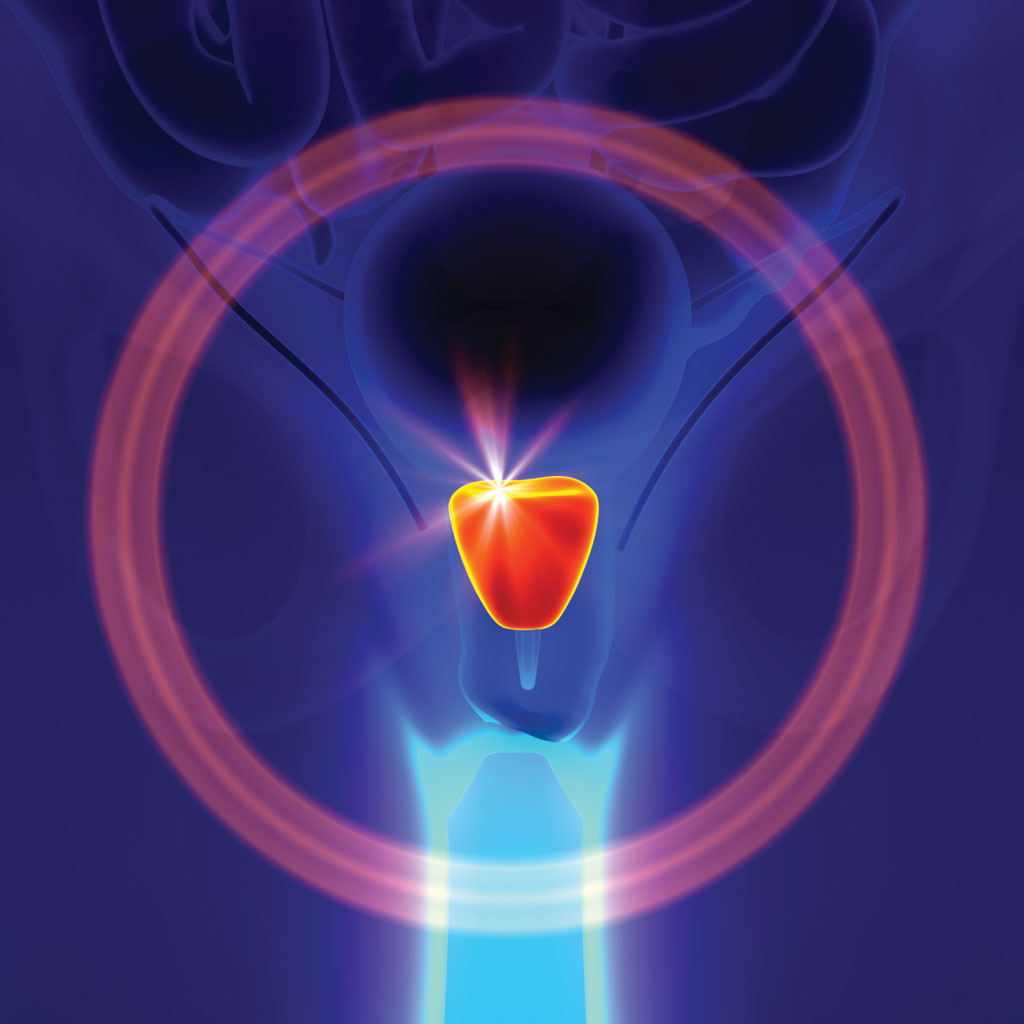 pae vs urolift