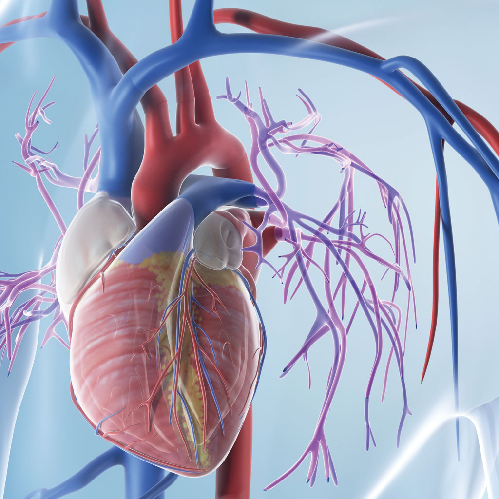 The Ins and Outs of IVC Filters - Memphis Vascular Center