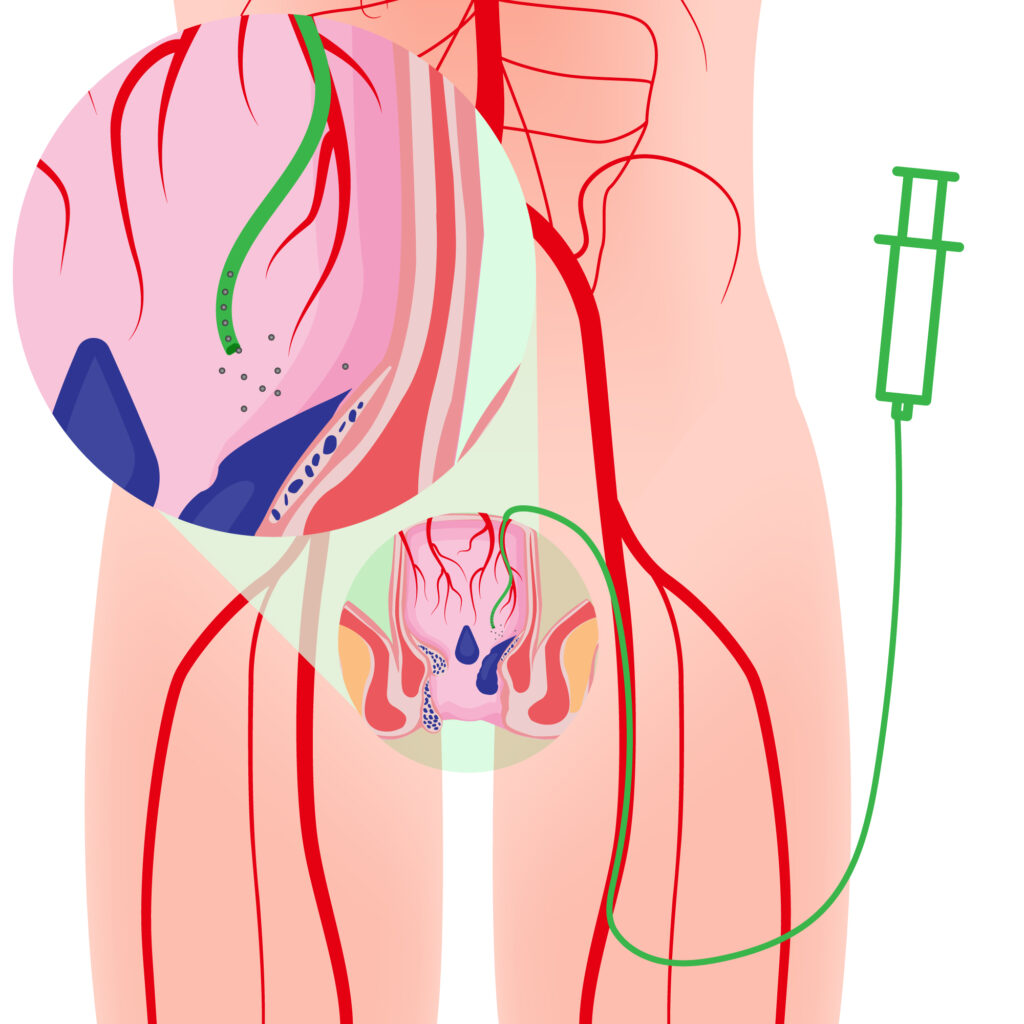 hemorrhoidal artery embolization (HAE)